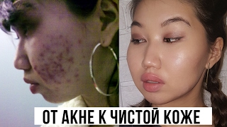 История Моей Кожи | Как я избавилась от акне. История Моей Кожи | Как я избавилась от акне.