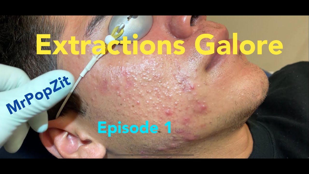 Pimples, Whiteheads and Blackheads Galore
