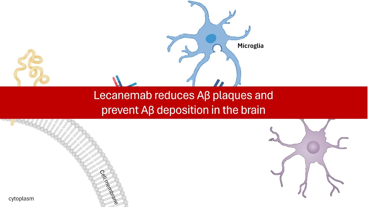 Lecanemab Rash Lecanemab: A Beacon of Hope for Alzheimer's Disease - YouTube