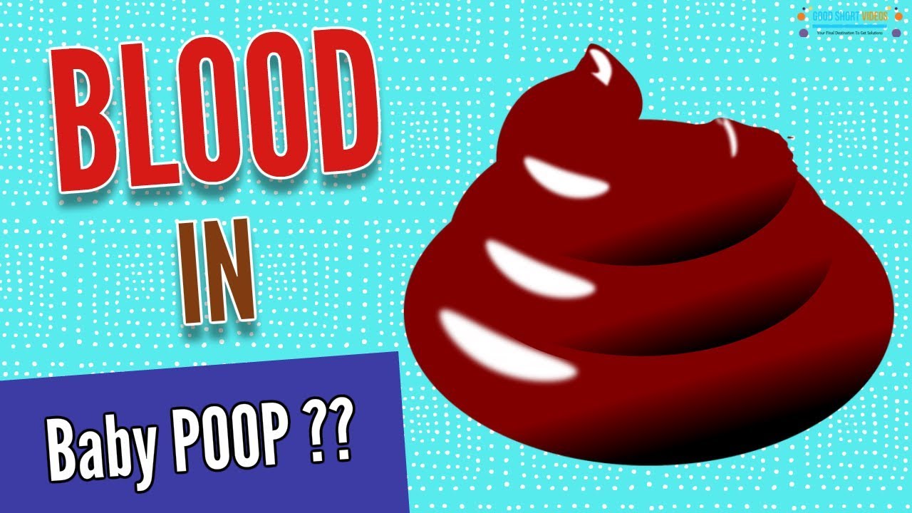 Blood In Infant Stool Common Cause Of Blood In An Infant s Stool