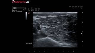 Cryoneurolysis of musculocutaneous nerve intramuscular in biceps brachii