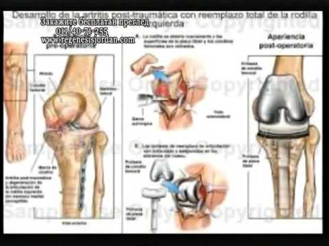 Video: Artritis: Kako Prepoznati In Obvladati Stanje