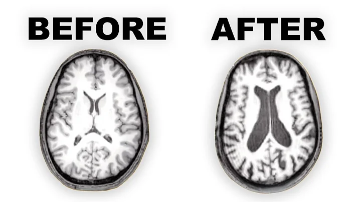 Long-term Effects of Antipsychotics on the Brain