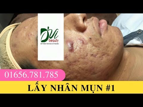 Lấy nhân mụn - Điều trị mụn tại Mỹ phẩm thiên nhiên D'vi Beauty #1