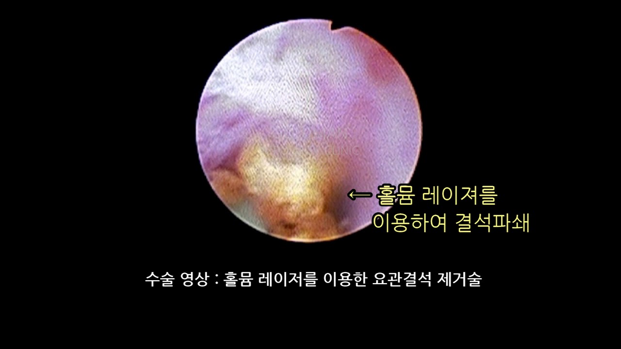요관결석 요로결석 홀뮴레이저 요관경하 요관 결석제거술 -골드만비뇨기과 - YouTube