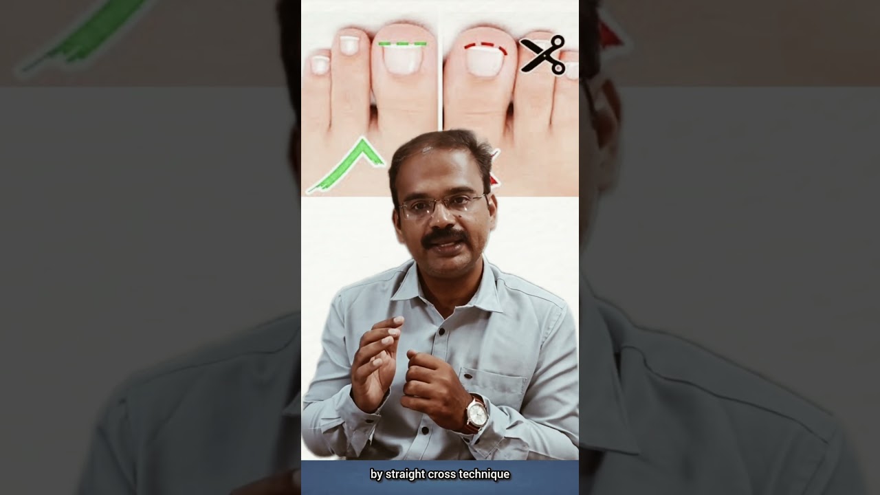10 SUPER TIPS – TO PREVENT DIABETIC FOOT ULCER.Dr.S.Ranjith Pratap & Dr.Innisai.#doctor # chennai