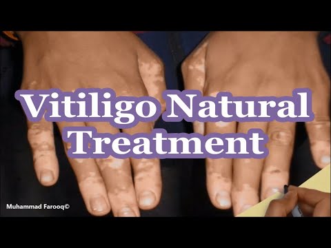 Cure For Vitiligo Found : vitiligo - Vedas Cure / Vitiligo is a