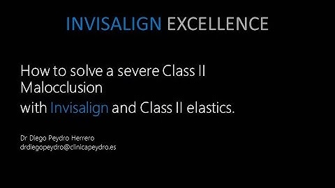 Invisalign Tips: How to solve a severe Class II with Invisalign and class II elastics