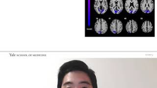 Famous Neurologic Functional Connectivity In Unicoronal Craniosynostosis: A Side-based Comparison Net Worth