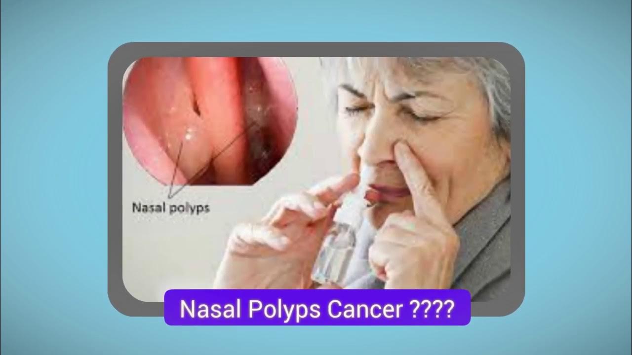 Nasal Polyps CancerIs My Nose Polyps Cancerous? YouTube