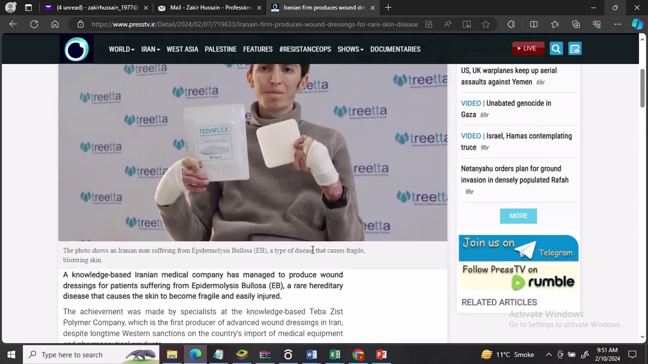 Iranian firm produces wound dressings for rare skin disease amid inhumane sanctions