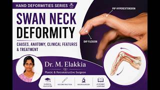 Swan Neck Deformity Explained | Causes, Anatomy, Clinical Features & Treatment | Plastic Surgery