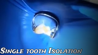 Rubber dam isolation for posterior teeth,  Clinical case