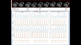 [S110] Deep Learning Regression of Cardiac Phase on Real-Time MRI