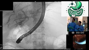Difficult stone EyeMax, Dr  Robles Medranda, Carlos, and Dr  Ammar Alotiabi, Saudi live endoscopy