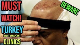 Things You Must Know About Turkey Hair Transplant Clinics