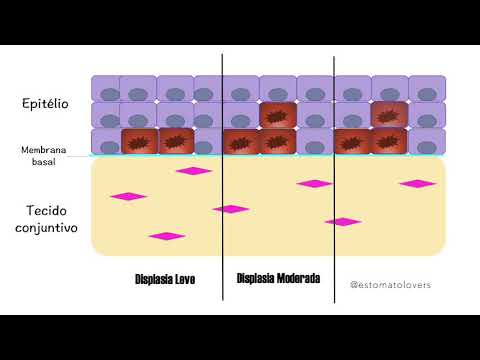 Vídeo: Quem é a displasia epitelial?