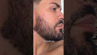Antes E Depois Minoxidil 1 Ano E 4 Meses De Tratamento
