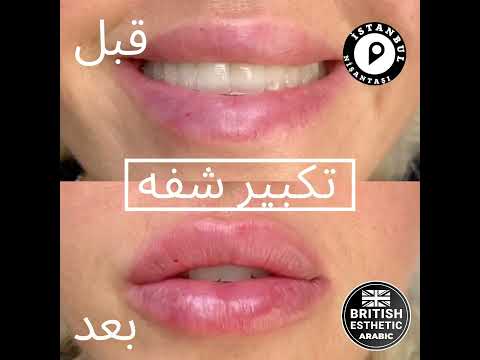 تكبير الشفايف