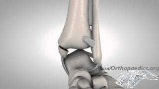 Lauge-Hansen pronation-abduction injury