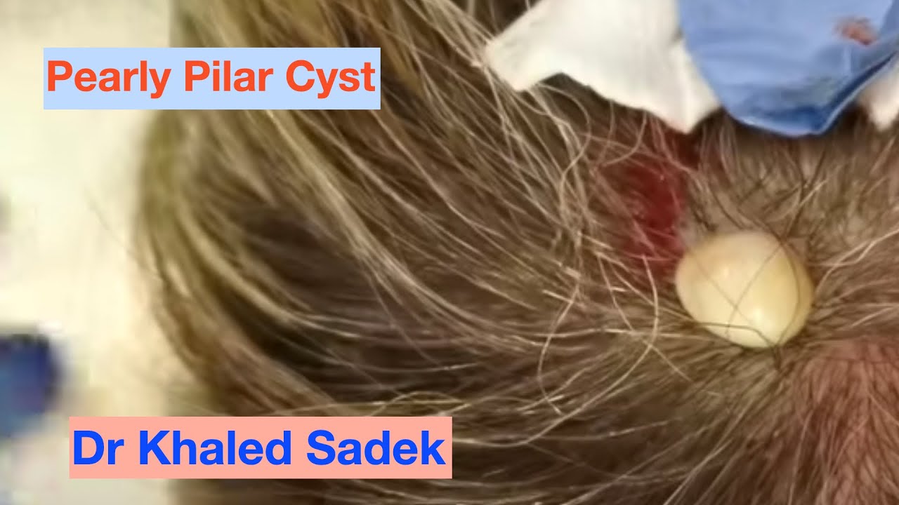 complete-pilar-cyst-removal-dr-khaled-sadek-lipomacyst-youtube