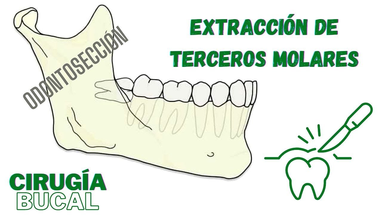 ODONTOSECCIÓN: Técnica de extracción de Terceros Molares - Dr. Han Choi