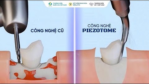 Piezotome – Giải pháp chăm sóc nụ cười hiện đại, nhẹ nhàng và tinh tế 😘💕