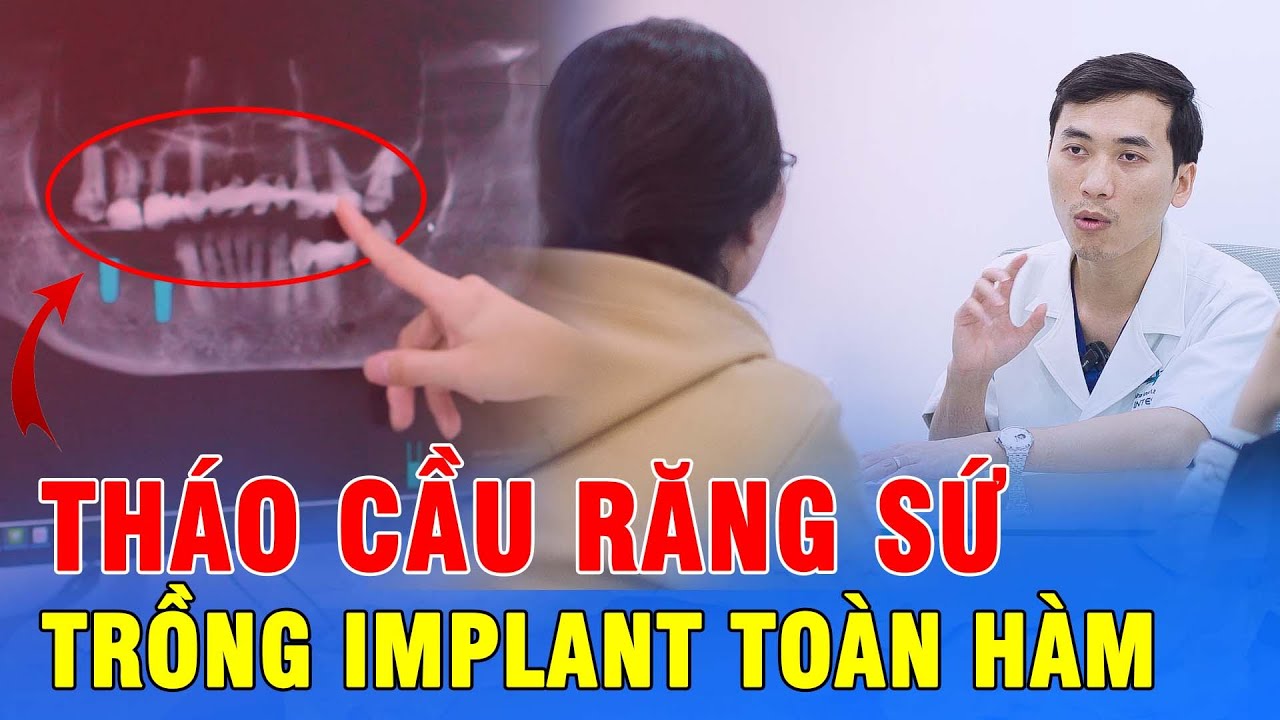 Vị khách hàng muốn tháo bỏ cầu răng sứ để trồng implant toàn hàm | Thăm khám & tư vấn thực tế