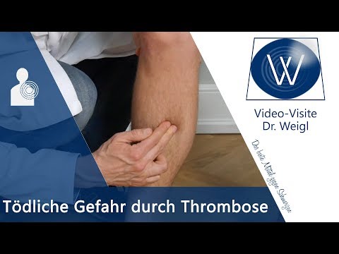 Video: Wenn ein Thrombus durch die wandert?