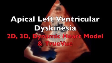 Apical Left Ventricular Dyskinesia: 2D, 3D, Dynamic Heart Model & TrueVue