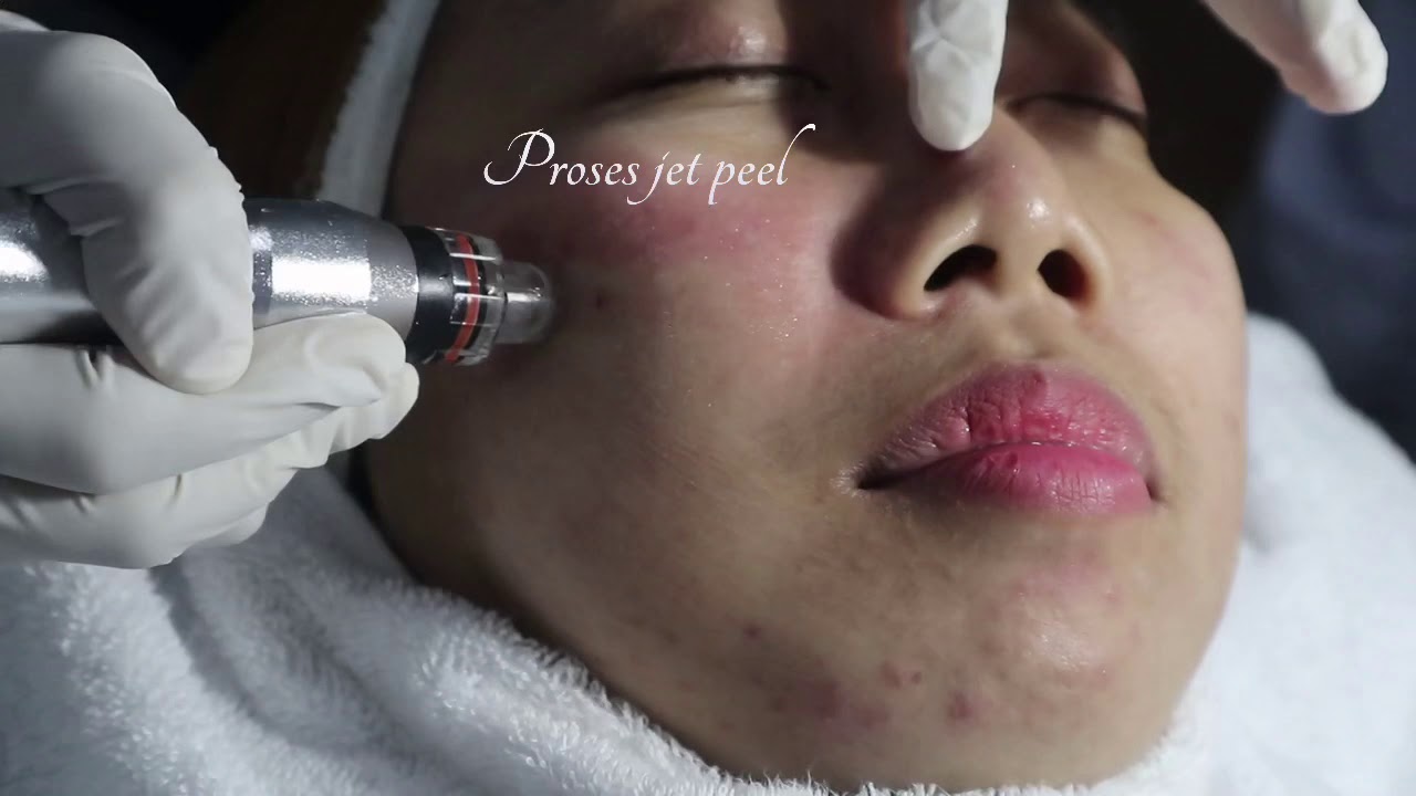 Jet peel 3in1 YouTube