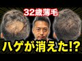 【30代薄毛】薄毛が目立たないヘアセットで大変身！