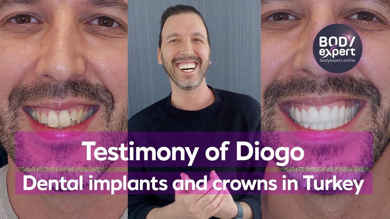 DENTAL IMPLANTS IN TURKEY | 🦷 Diogo's testimony: 5 implants + bone graft + 28 crowns | BODYEXPERT
