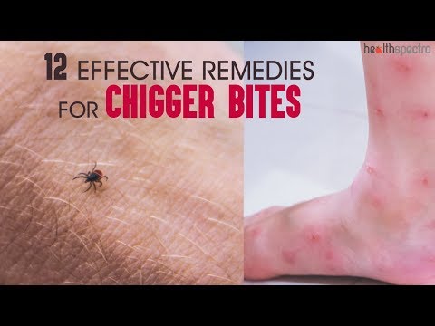 12 Effective Remedies For Chigger Bites | Healthspectra