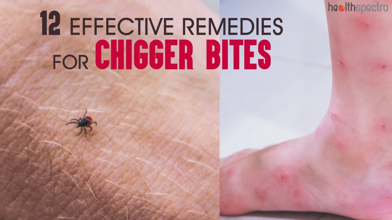 Does Vinegar Help Chigger Bites?