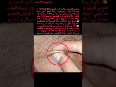 أختبار مرونة وجفاف الجلد كيف تعرف أن عندك جفاف داخلي با الجسم Shorts Youtubeshorts 