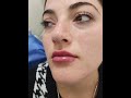 💉👄Aumento y perfilado de labios con ácido hialurónico#lips #lipsfiller