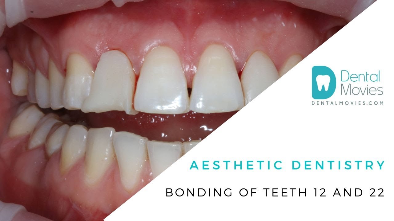 Aesthetic dentistry bonding of teeth 12 and 22 YouTube
