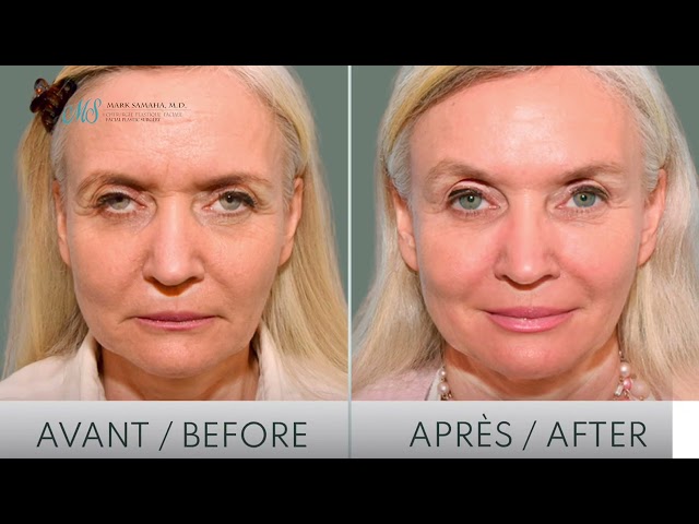 Brow Lift Patient Testimonial: Brow Lift Surgery Review