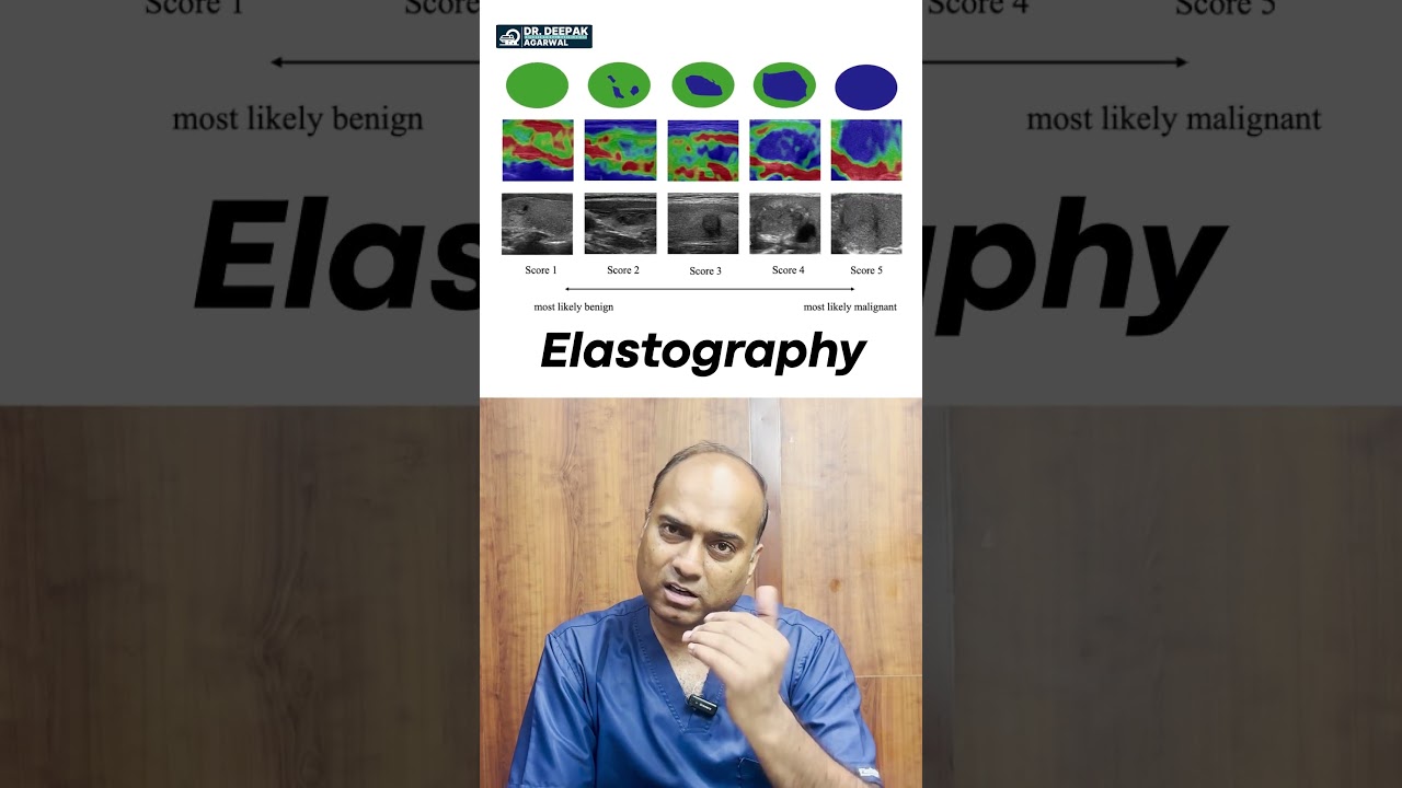 FNAC Test & Ultrasound for Thyroid Nodule | गले की गांठ: Cancer Risk Kaise Pta Kare | Thyroid cancer