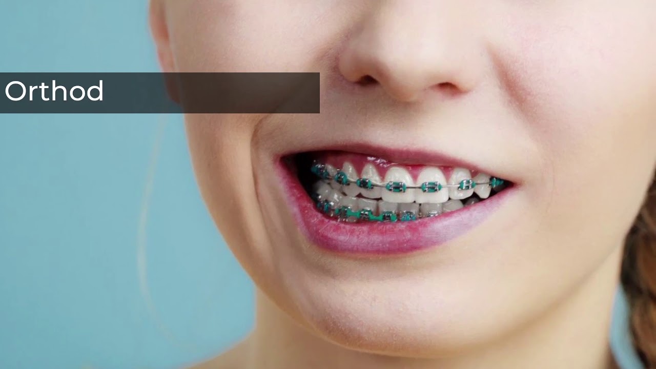 Брекеты на зубы для детей сколько стоят
