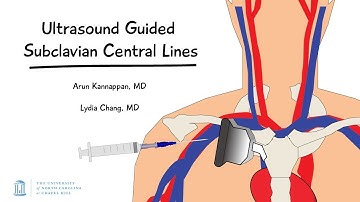 Ultrasound Guided Subclavian Central Lines -- BAVLS