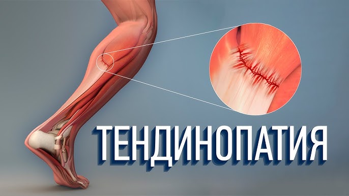 ОСОБЕННОСТИ КЛИНИЧЕСКОЙ КАРТИНЫ Тендинит коленного сустава