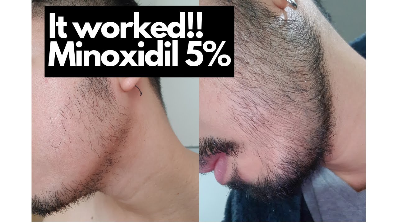 Minoxidil Beard Journey ⎮Do we grow beard if we use minoxidil? ⎮ YES!!!! YouTube