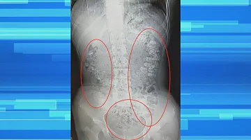 Are bubble tea pearls digestible?