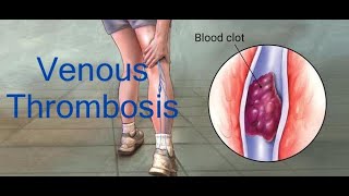 Venous Thrombosis by ASM Minds Team