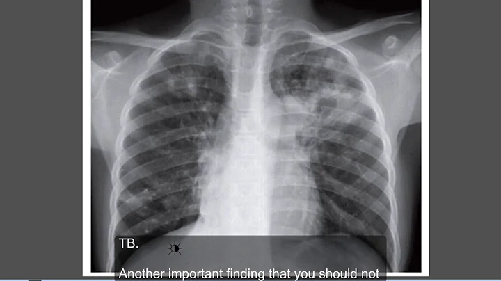 Tuberculosis,  Active TB ,  Chest x ray - DayDayNews