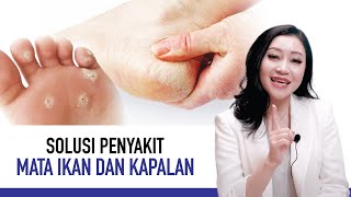 Mata Ikan dan Kapalan Bikin Kulit Keras, Ini Penyebab dan Cara Mengatasinya | Kata Dokter