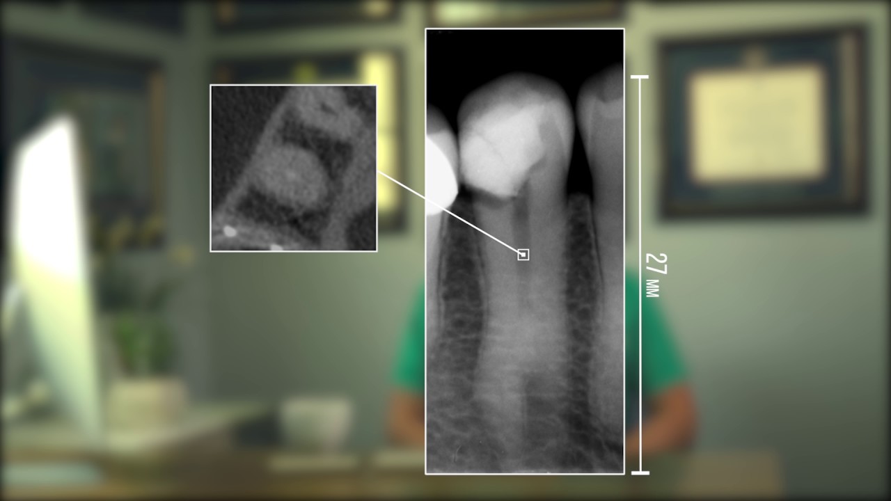 Modern Endodontic Practice Case 1 Cshaped mandibular premolar Dr