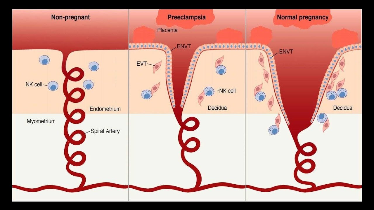 Preeclampsia Chart